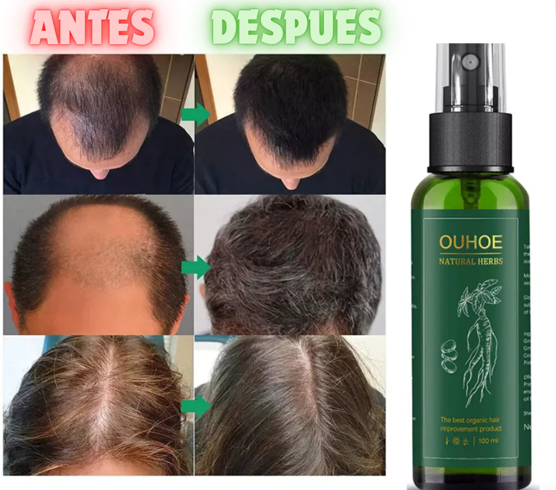 OUHOE-✨ Recupera tu Cabello en Semanas- Tratamiento Capilar